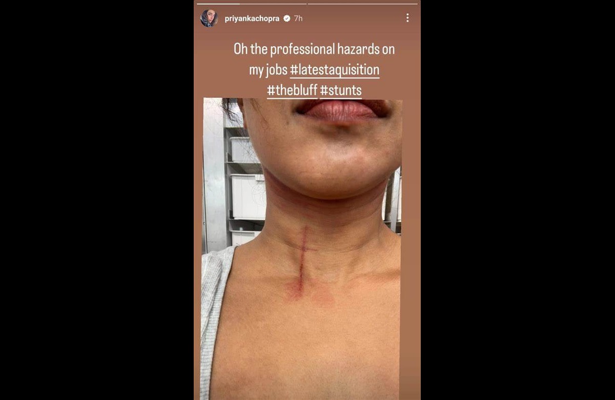Priyanka Chopra injures